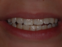 After Fastbraces
