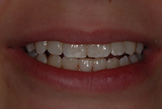 After Fastbraces