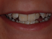 Before Fastbraces