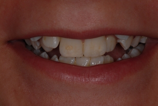 Before Fastbraces