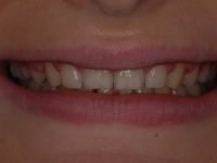 Before Fasbraces