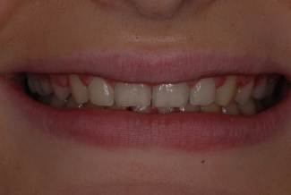 Before Fasbraces