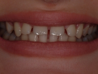 Before Fasbraces