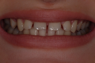 Before Fasbraces