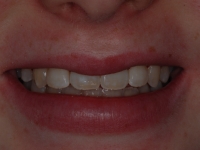 After Fastbraces