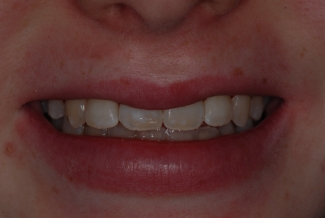 After Fastbraces