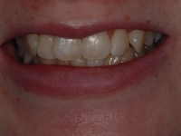 Before Fastbraces