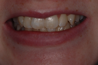 Before Fastbraces