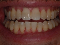After Fastbraces