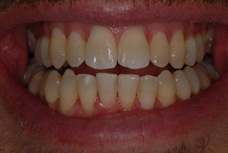 After Fastbraces