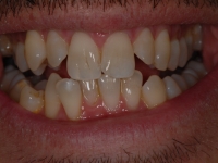 Before Fastbraces