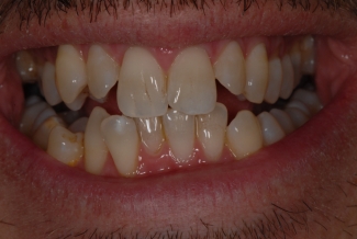 Before Fastbraces