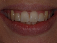 After Fastbraces
