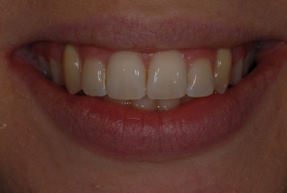 After Fastbraces