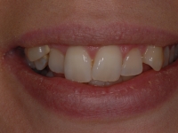 Before Fastbraces