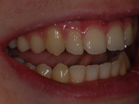 After Fastbraces