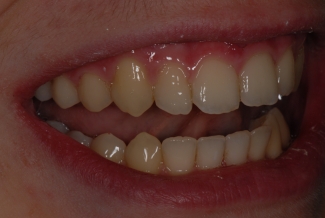 After Fastbraces