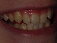 Before Fastbraces