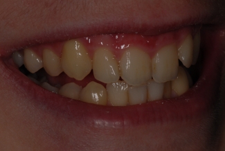 Before Fastbraces