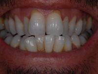 Before Veneers