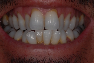 Before Veneers