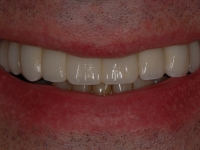 After Veneers and Bridges