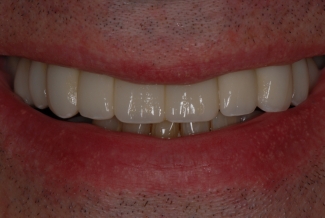 After Veneers and Bridges