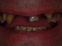 Before Veneers and Bridges