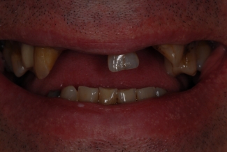 Before Veneers and Bridges