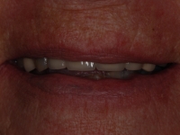 Before Veneers