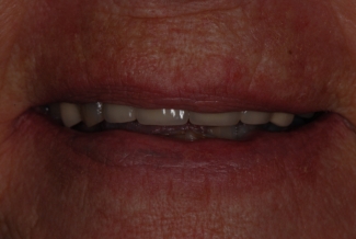 Before Veneers