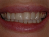 Before Veneers