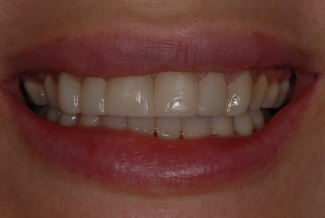 Before Veneers