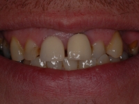 Before Veneers