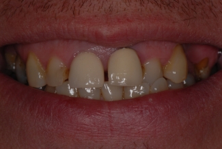 Before Veneers