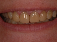 After Composite Bonding