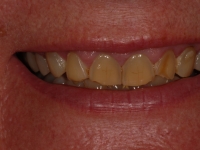 Before Composite Bonding