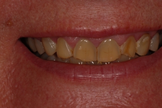 Before Composite Bonding