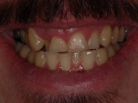 Before Fastbraces and Composite Bonding