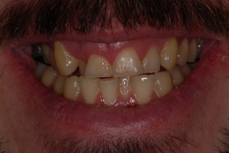 Before Fastbraces and Composite Bonding