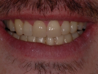 9-after