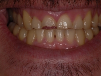 Before Fatsbraces