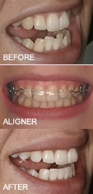 inman aligner braces Parkstone Dental Practice