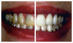 teeth whitening comparison on Poole client