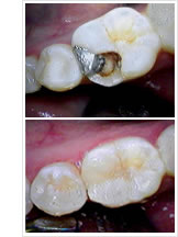 white composite fillings