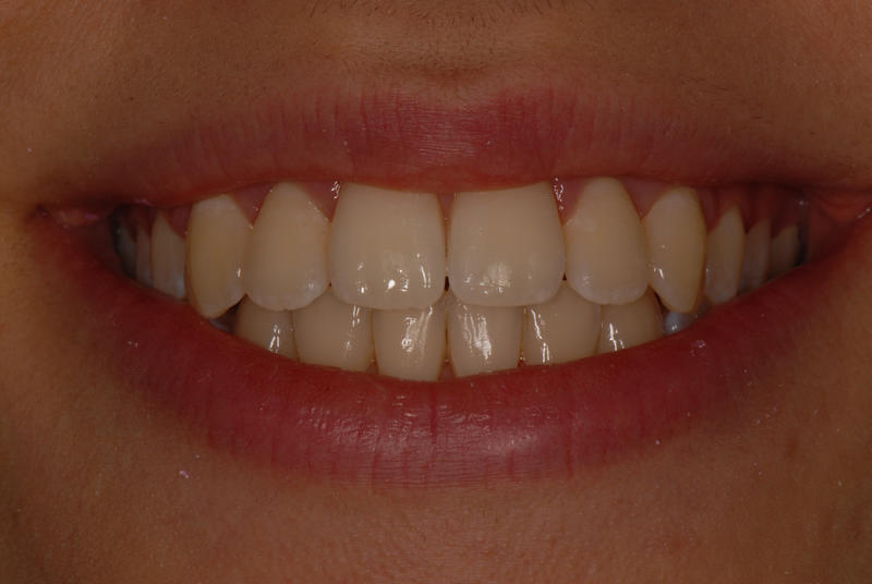 After Fastbraces fitted at Parkstone Dental Practice, Poole