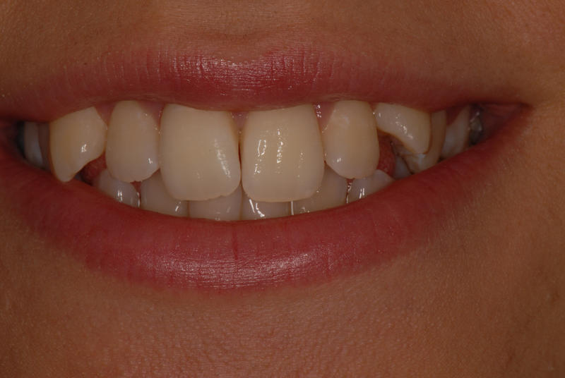 Before Fastbraces fitted at Parkstone Dental Practice, Poole